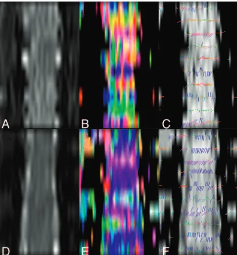 Fig 5. Fiber-tracking results from a healthy control (fibers appear to converge on an emerging nerve root, suggesting that fiber crossing maybe present