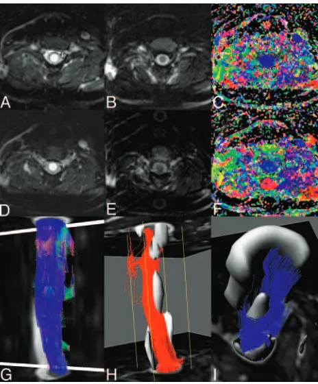 Fig 7. T2 (left column), and diffusion-weighted images (middle column) together with FAmaps (right column) of a cervical spine lesion in a patient with multiple sclerosis