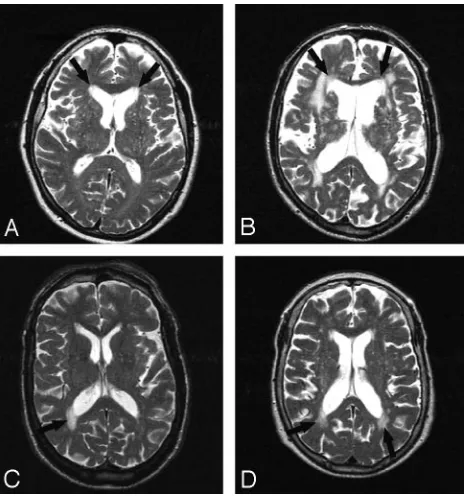 Fig 1. Different types of PVWMH. Examples of frontal PVWMH with a smooth lining (A,right and left) and frontal PVWMH with an irregular lining (B, right and left) and examplesof occipital PVWMH with smooth (C, right) and irregular (D, right and left) linings.