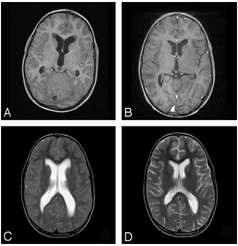 Table 2: Magnetization transfer ratio (MTR) values of smooth andirregular lesions in frontal and occipital white matterhyperintensities