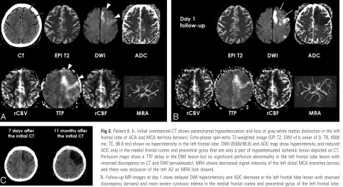 Fig 2. Patient 8. A, Initial unenhanced CT shows parenchymal hypoattenuation and loss of gray-white matter distinction in the left