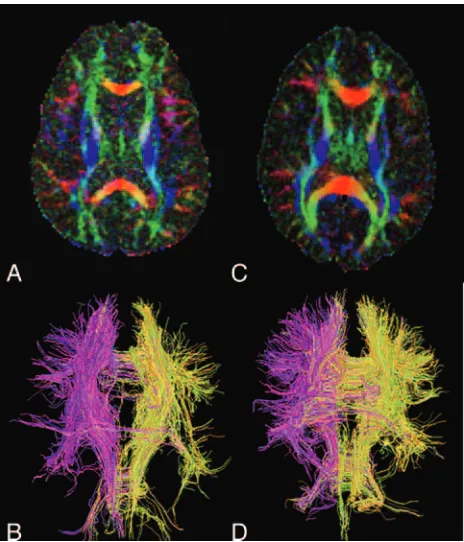 Fig 5. Diffusion anisotropy maps and diffusion tensor imaging-based white matter trac-tography of a representative boxer (A and B; 27 years old) and a control (C and D; 29 yearsold)