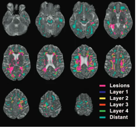 Fig 1. T2-weighted images coregistered to the T1 maps illustrating the definition of pixelclasses in 1 female patient with primary progressive MS (aged 59.5 years; diseaseduration, 8.3 years; cerebral lesion volume, 14.9 mL; EDSS score, 4.0; MSFC score, 0.