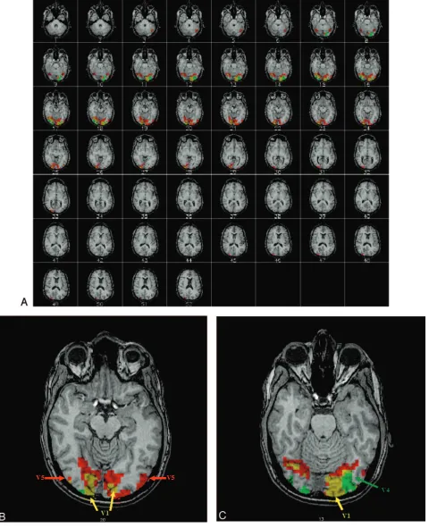 Fig 2. Single subject activation maps to the M (in the brain, and theanatomic image. The regions showing overlapping M and P activity arered) and P (green) stimuli