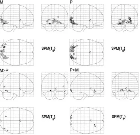 Fig 3. Group analysis of the 6 subjects. The images are in neurologic convention (ie, leftmultiple comparison ofis left)