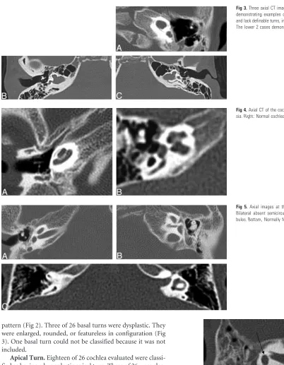 Fig 3. Three axial CT images at the level of the cochlea