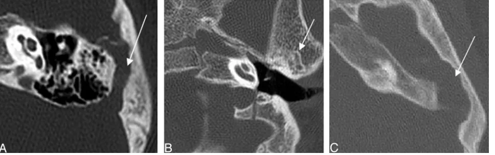 Fig 11. Three axial CT images demonstrating examples of petrosquamosal sinuses (white arrows), a form of emissary vein anomaly.