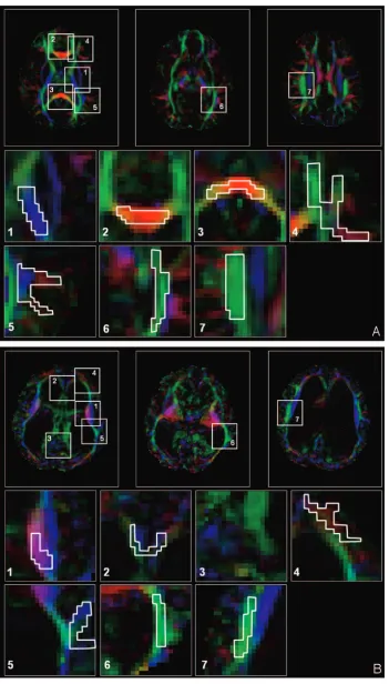 Fig 1. ROI selection in a control subject (one can define specific white matter fascicules.A) and a patient with acute HCP (B)