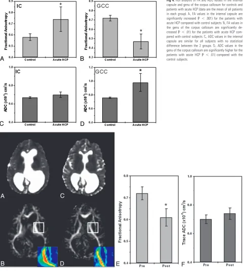 Fig 4. ROI analysis of FA and ADC values in the internalpared with control subjects.capsule are similar for all subjects with no statisticaldifference between the 2 groups.genu of the corpus callosum are significantly higher for thepatients with acute HCP 
