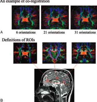 Fig 1. A, An example of coregistration across 3 protocols.Images on the left, middle, and right are obtained with the6-NDGD, 21-NDGD, and 31-NDGD protocols, respectively.A region of interest (ROI) of the splenium of CC is initiallydrawn on only 1 image from 1 of the 3 protocols and thentranslated to the corresponding images from the other 2protocols.