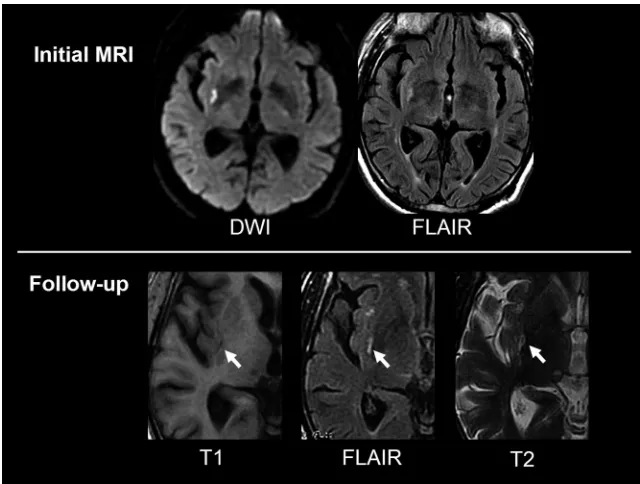 Table 1: Characteristics of transient ischemic attack (TIA) patients with and without infarction on follow-up MR imaging (MRI)