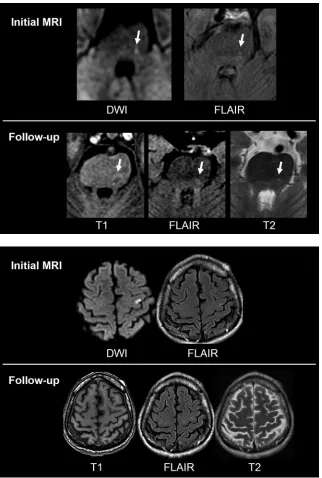Fig 2. A 63-year-old man with a right sensory deficit forafter onset), a small permanent injury can be seen as adark signal intensity on T1-weighted sequence and abright signal intensity on FLAIR/T2-weighted sequence in10 hours