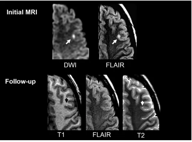 Table 2: Quantitative diffusion-weighted MR imaging (DWI)–derivedvariables of the 59 transient ischemic attack (TIA) lesionsaccording to imaging outcome