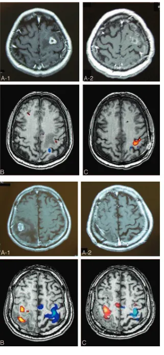 Fig 1. Case 1. A 57-year-old woman with metastatic brain