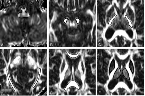 Fig 1. Examples of region of interest placement for mean diffusivity (MD) and fractional anisotropy (FA) measurements