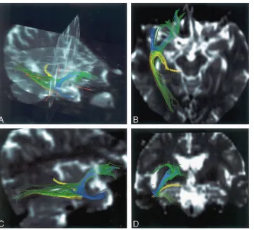 Fig 1. Tractographies were drawn by us-right;ADC values were measured along theseing diffusion-weighted images (EPI imag-ing: TR/TE, 2300/122 ms; b � 1000 sec-onds/mm2; 6-axis encoding; FOV, 230 mm;matrix, 128 � 128; section spacing, 3.3mm; section thickne