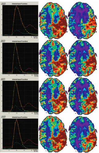 Fig 5. Differences between CBV and CBF parameterwith brain AVM. Note that AIF curves are sharper withthe regional and regional scaled methods, mainly be-cause of AIF positioning and increased CBF values ingray matter cortices (green)