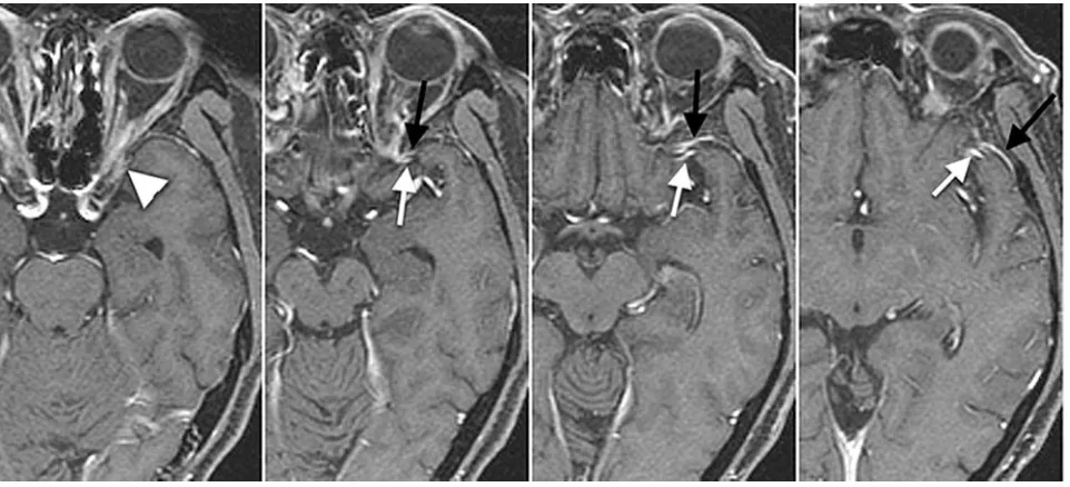 Fig 1. Schematic drawings of variations of the SMCV. Type A, SMCV connects with the proximal SPS and flows into the frontal aspect of the cavernous sinus