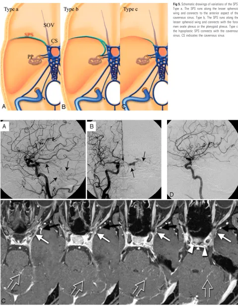 Fig 5. Schematic drawings of variations of the SPS.Type a, The SPS runs along the lesser sphenoidwing and connects to the anterior aspect of thecavernous sinus