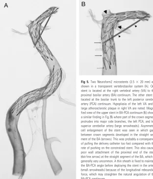 Fig 4. Magnified view of the upper stent (Neuroform2 microstent with the size of 3.520 mm) shown in Fig 2