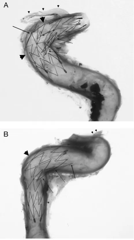 Fig 7. A 3.5 � 20-mm Neuroform2 microstent deployed from the terminal end of theinternal carotid artery to the middle cerebral artery