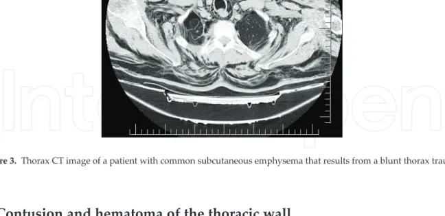 Figure 3. Thorax CT image of a patient with common subcutaneous emphysema that results from a blunt thorax trauma.
