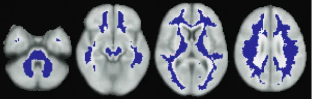 Fig 1. To analyze normal-appearing white matter(NAWM), MR visible lesions were excluded