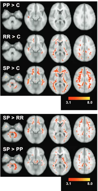 Fig 3. Results of pairwise contrasts between multiplesclerosis (MS) groups (primary progressive [PP], relaps-ing-remitting [RR], and secondary progressive [SP]) andcontrol subjects (C) are displayed as Z scores for PPMS � control subjects (top), RR MS � co