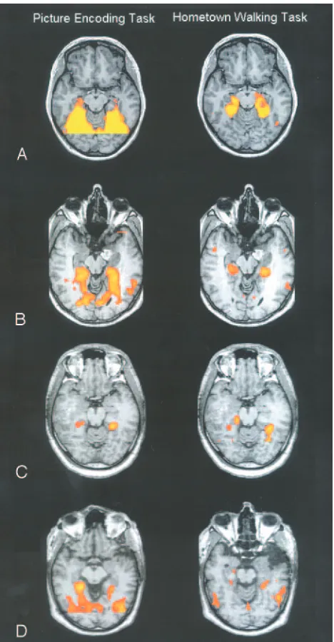 Fig 1. Functional activation results for the picture-encoding task (left) and the hometown-walking task (right)