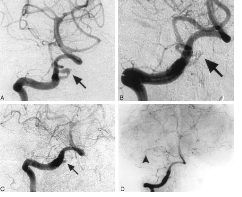 Fig 1. Case 1. Images of a 48-year-old woman with a dissecting aneurysm of the right PICA.AICA (CA, Angiogram shows a dissecting aneurysm arising from the lateral medullary segment of the right PICA (arrow).B, Angiogram obtained after embolization of the d