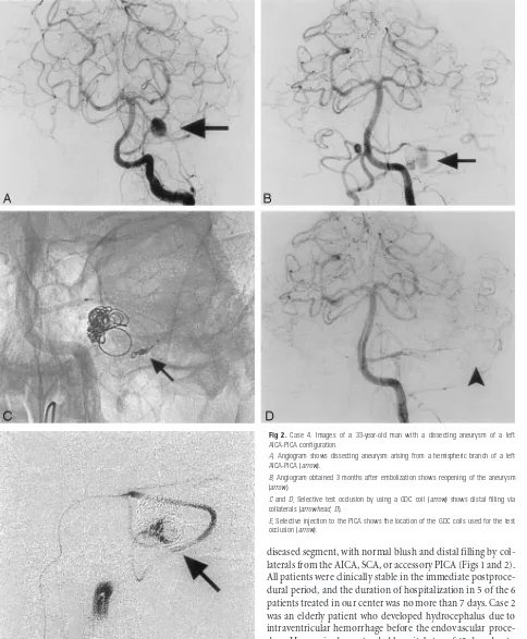 Fig 2. Case 4. Images of a 33-year-old man with a dissecting aneurysm of a leftcollaterals (AICA-PICA configuration.A, Angiogram shows dissecting aneurysm arising from a hemispheric branch of a leftAICA-PICA (arrow).B, Angiogram obtained 3 months after embolization shows reopening of the aneurysm(arrow).C and D, Selective test occlusion by using a GDC coil (arrow) shows distal filling viaarrowhead, D).E, Selective injection to the PICA shows the location of the GDC coils used for the testocclusion (arrow).