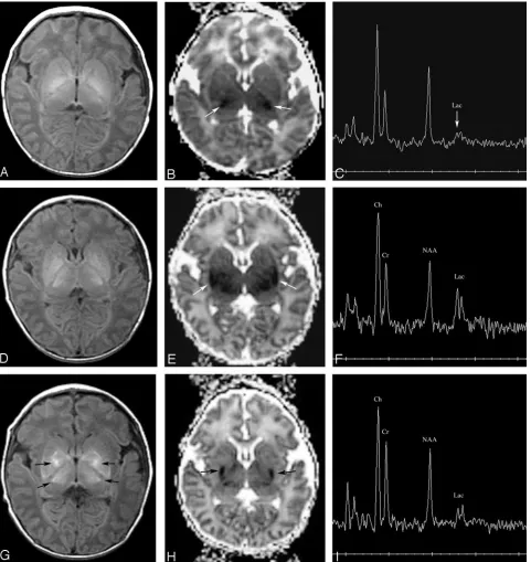Fig 4. Patient 178. Evolution of T1, diffusivity, and metabolites over 3 scans during 8 days.were performed at 8 days (178 hours).A,B,Measurements showed that the DC,D, A–C were performed at day 1 (16 hours), D–F were performed at 4 days (84 hours), and G–