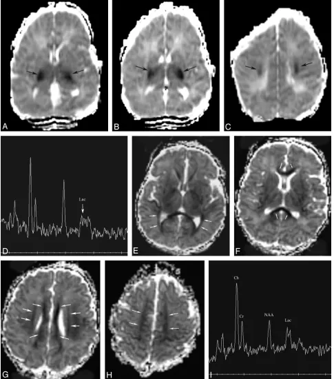 Fig 5. Patient 193. New involvement of white matter pathways on second study. Studies performed at day 2 and day 7.tracts in centrum semiovale