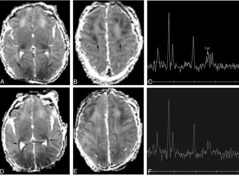 Fig 6. Patient 154. Increased volume of injury in vascular boundary zones from 2 to 4 days.A and B, Axial Dav maps at 49 hours show reduced diffusivity (Dav reduced by about 20%, black arrows) in the frontal and parietooccipital intervascular boundary zone