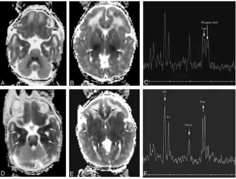 Fig 2. Patient 163. Increasing abnormality from day 1 to day 3.