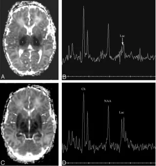 Fig 3. Patient 170. Increasing abnormality from day 2 to
