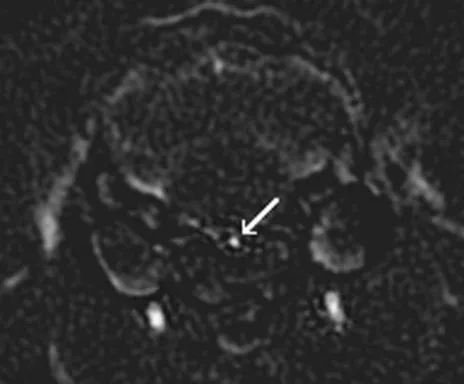 Fig 1. Subtracted CT angiographic image of a contrast enhanced section through themiddle segment of the basilar artery (white arrow).