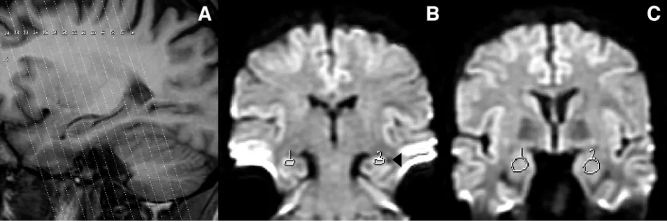 Fig 1. A, Highlight of a T1-weighted sagittal scout imaging from a control subject with the tilted coronal diffusion partitions superimposed