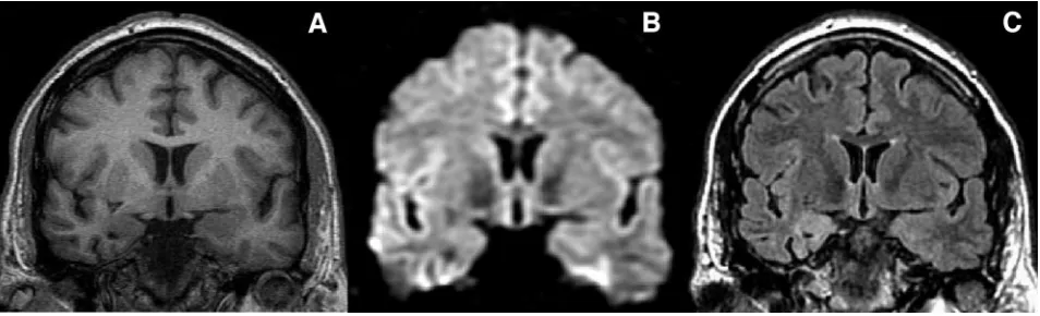 Fig 3. Tilted coronal sections from a patient with right HS illustrating the morphologic (diffusion-weighted image (A) and signal intensity (C) characteristics of a damaged right hippocampus
