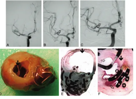 Fig 1. Ruptured aneurysm of the PComA removed 2 months after treatment with GDCs (case 10, Tables 1 and 2).B,A, Digital subtraction angiography (DSA) before treatment demonstrates PComA aneurysm.C, DSA immediately following treatment demonstrates minimal n
