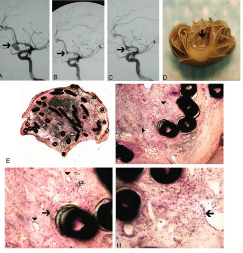 Fig 3. Ruptured aneurysm of the AComA, treated with Matrix coils and removed during surgery 6 months later (case 18, Tables 1 and 2).H,A, DSA before treatment demonstrates ruptured AComA aneurysm (arrow) and a small incidental aneurysm at the pericallosal 