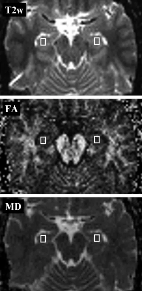 Fig 1. Placement of regions of interest. Regions of interest (5.4measurement of hippocampal FA (( � 7.2 � 3.0 mm) for themiddle) and MD (bottom) values