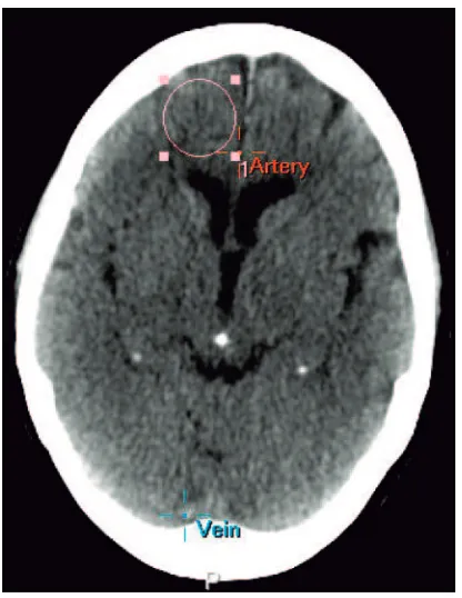 Fig 1. A circular region of interest with a standard size of 2.5 cm in diameter was drawnin the peripheral anterior flow territory at the level of the basal ganglia on a standardlocation containing both white and gray matter