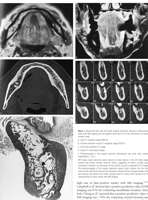 Fig 6. A 69-year-old man with left lower gingival carcinoma showing a false-positive