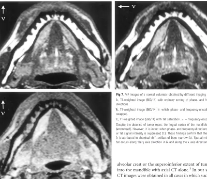 Fig 7. MR images of a normal volunteer obtained by different imaging methodsDespite the absence of tumor mass, the lingual cortex of the mandible is obscured inAfat occurs along theor fat signal intensity is suppressed (A, T1-weighted image (560/14) with o
