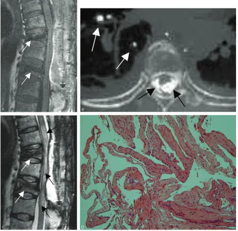 Fig 1. Case 1.change in the spinal cord on the T2-weighted images, because of compressive myelopathy or previous thermal injury