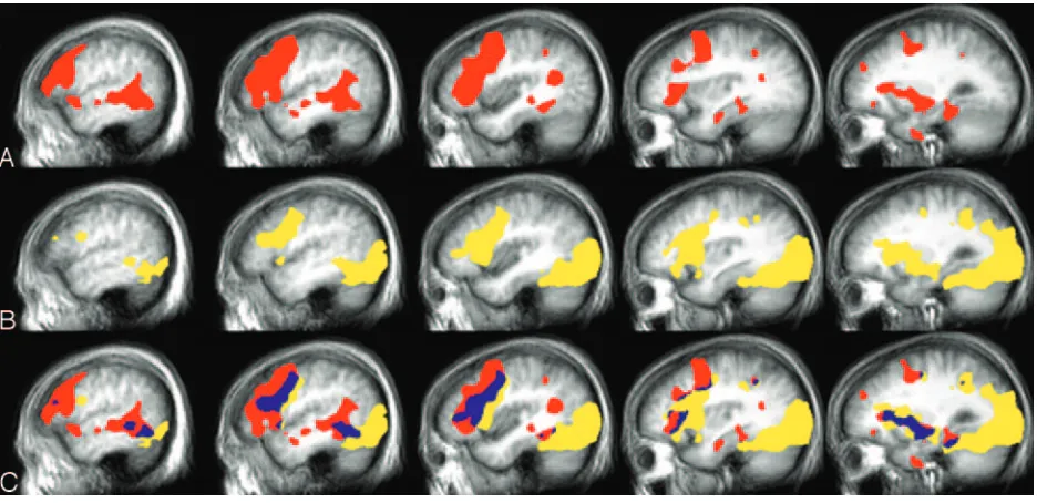 TABLE 1: Group results: left hemisphere temporal lobe
