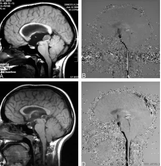 TABLE 2: Relationship between hydrocephalus etiology and clinical outcome