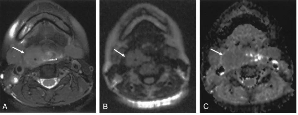 FIG 1.Axial images obtained in a 46-year-old woman with moderately differentiated SCC of the hypopharynx.A, T2-weighted fat-suppressed MR image shows a mass (arrow) in the upper right pyriform sinus.B, LSDWI obtained with b � 1000 s/mm2 shows a mass (arrow