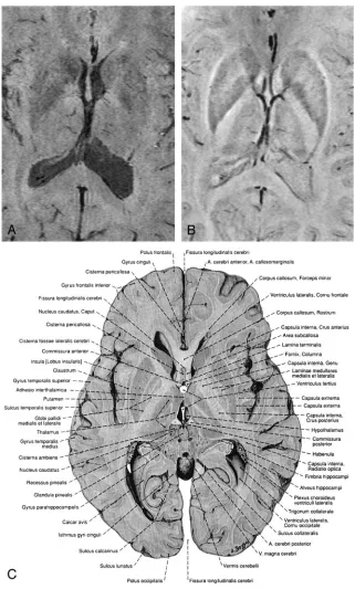 FIG 3. Minimum intensity projections over4 sections of magnitude image (A), thecorresponding high-pass filtered phaseimages (B), and a reproduction from ananatomic atlas (C)